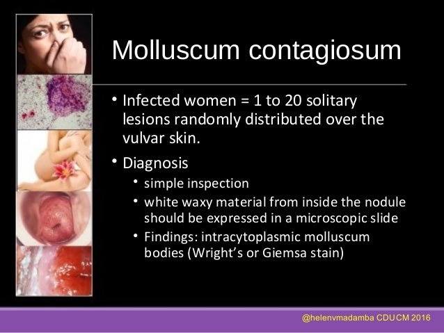 molluscum contagiosum vagina Nude fan art galleries